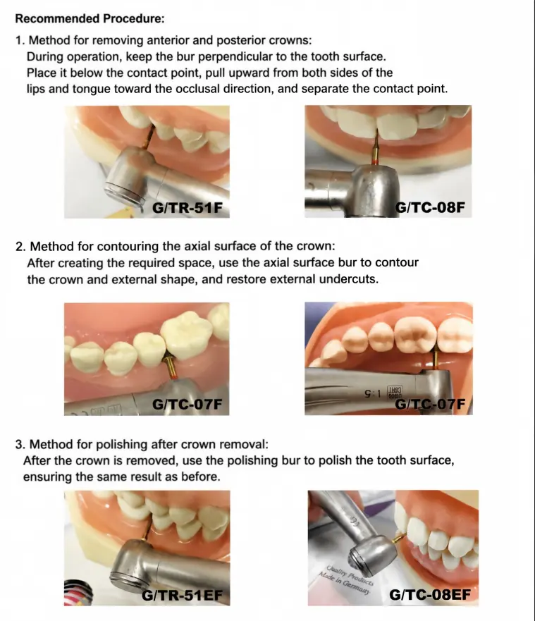 Crown Removal Procedure Guide